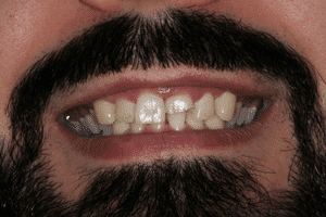 Aufnahme des Gebisses vor der Behandlung beim Zahnarzt in Ungarn.