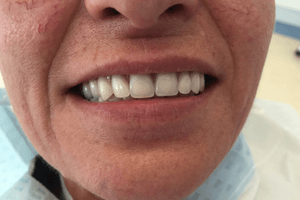Aufnahme des Gebisses nach der Behandlung beim Zahnarzt in Ungarn.