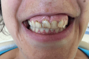 Aufnahme des Gebisses vor der Behandlung beim Zahnarzt in Ungarn.
