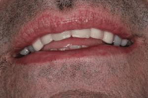 Aufnahme des Gebisses nach der Behandlung beim Zahnarzt in Ungarn
