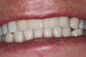 Aufnahme des Gebisses nach der Behandlung beim Zahnarzt in Ungarn.