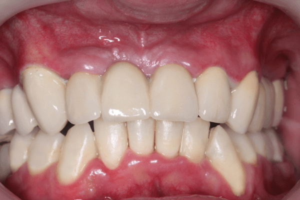 Aufnahme des Gebisses nach der Behandlung beim Zahnarzt in Ungarn