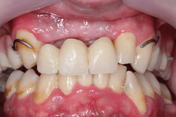 Aufnahme des Gebisses vor der Behandlung beim Zahnarzt in Ungarn