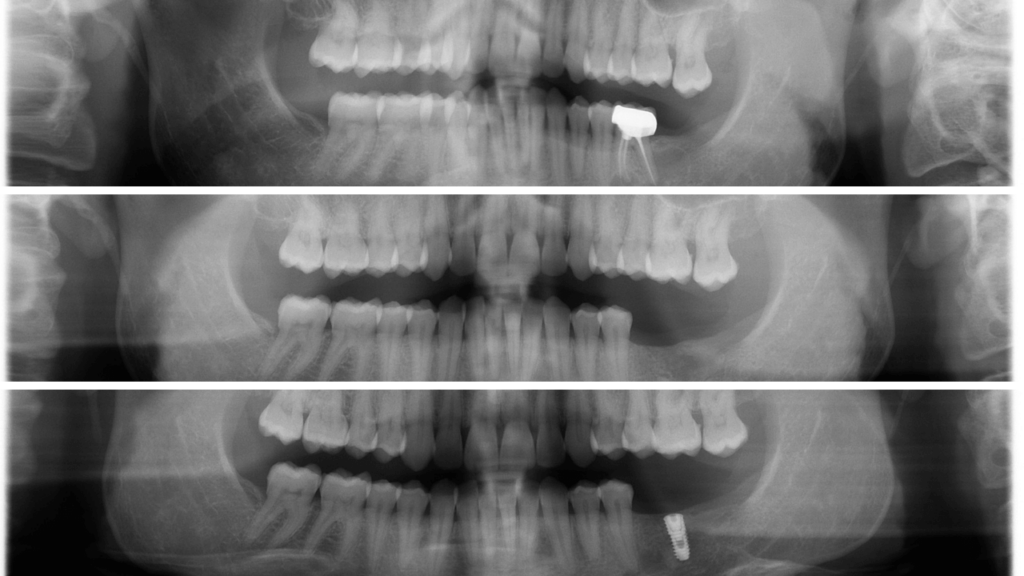 Zahnentfernung und Implantation gleichzeitig? Zahnröntgen - Artdent Zahnklinik, Budapest