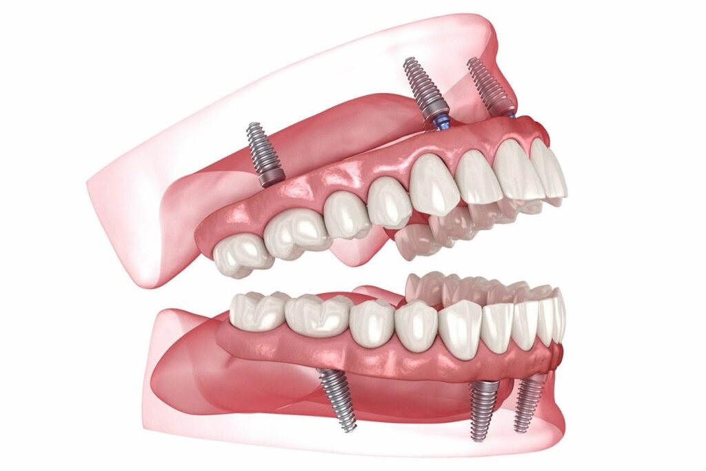 Beide Lösungen werden von Implantaten im Kieferknochen getragen — der Unterschied liegt im Zahnersatz darüber.